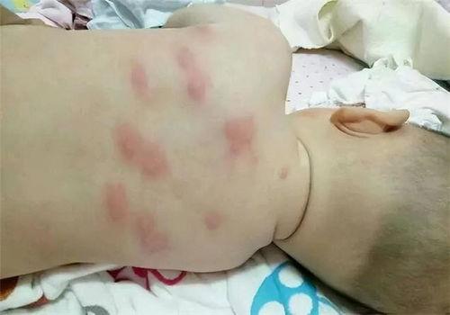 被跳蚤咬后的图片,红肿瘙痒，如何应对
